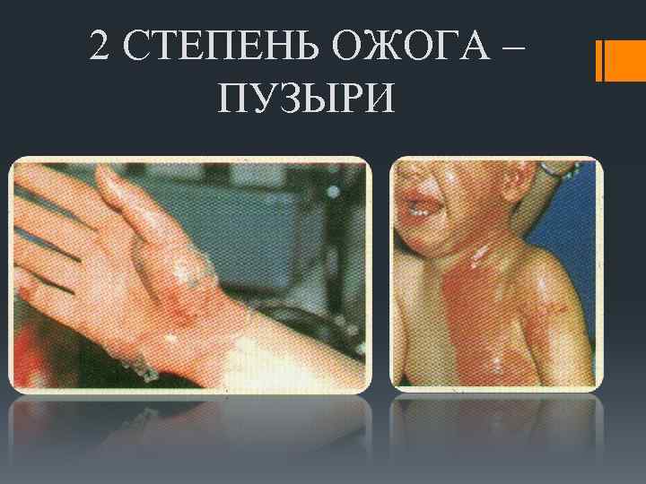 2 СТЕПЕНЬ ОЖОГА – ПУЗЫРИ 