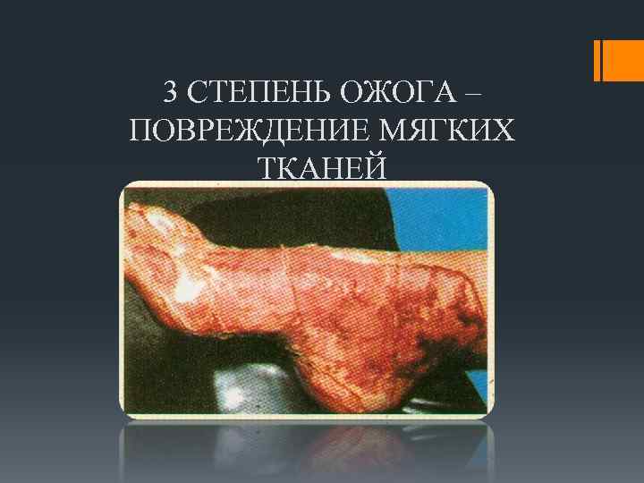 3 СТЕПЕНЬ ОЖОГА – ПОВРЕЖДЕНИЕ МЯГКИХ ТКАНЕЙ 