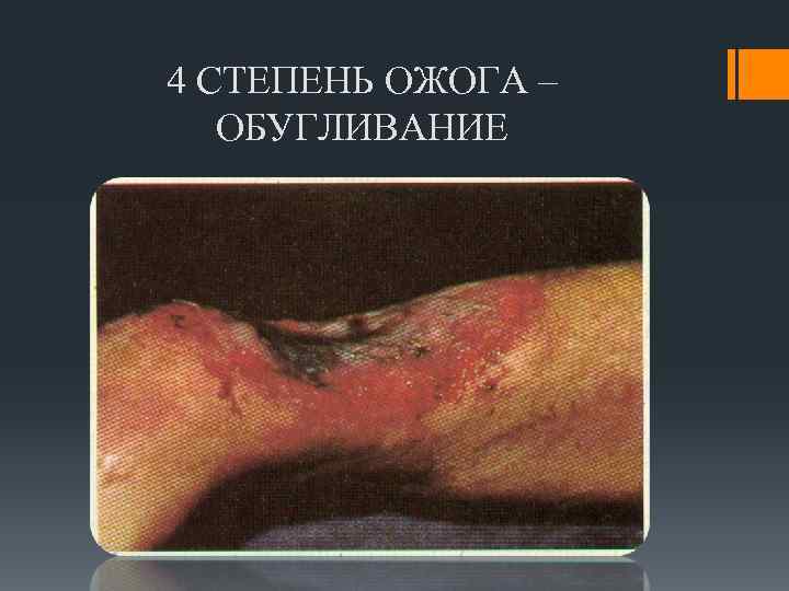 4 СТЕПЕНЬ ОЖОГА – ОБУГЛИВАНИЕ 