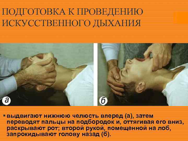 ПОДГОТОВКА К ПРОВЕДЕНИЮ ИСКУССТВЕННОГО ДЫХАНИЯ § выдвигают нижнюю челюсть вперед (а), затем переводят пальцы