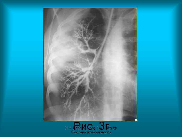 Рис. 3 г Н. С. Воротынцева. С. С. Гольев Рентгенопульмонология 