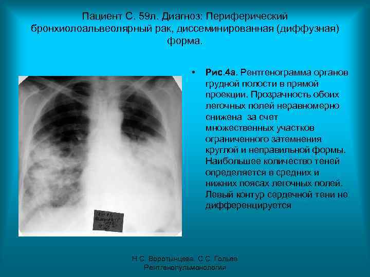 Пациент С. 59 л. Диагноз: Периферический бронхиолоальвеолярный рак, диссеминированная (диффузная) форма. • Рис. 4