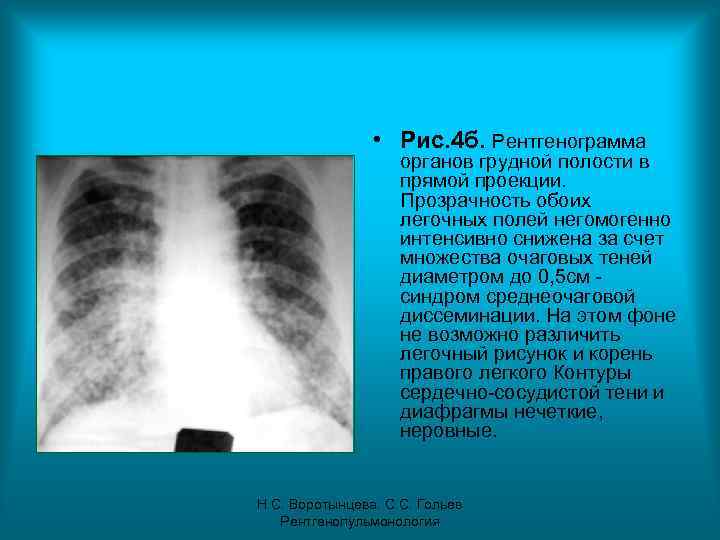  • Рис. 4 б. Рентгенограмма органов грудной полости в прямой проекции. Прозрачность обоих