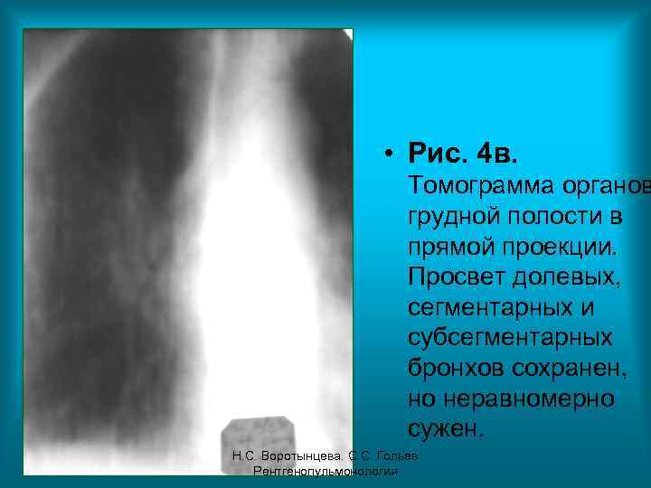  • Рис. 4 в. Томограмма органов грудной полости в прямой проекции. Просвет долевых,