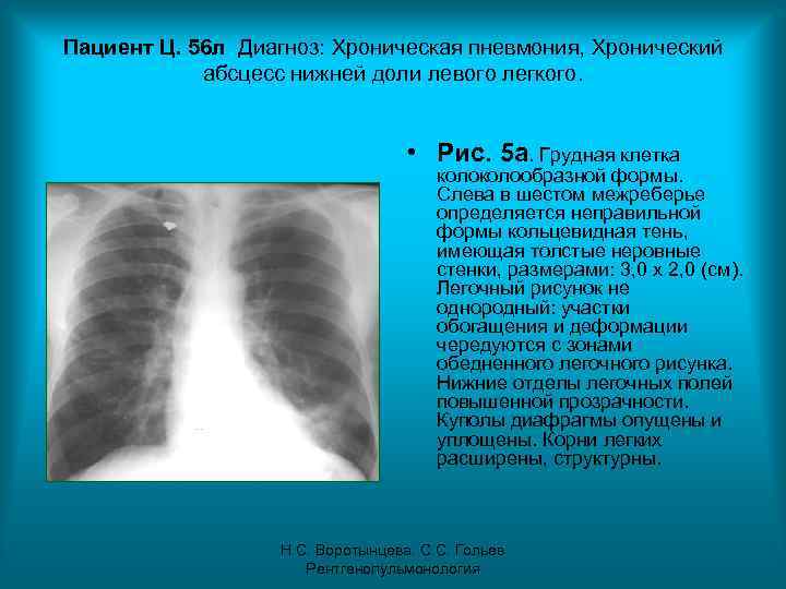 Пациент Ц. 56 л Диагноз: Хроническая пневмония, Хронический абсцесс нижней доли левого легкого. •