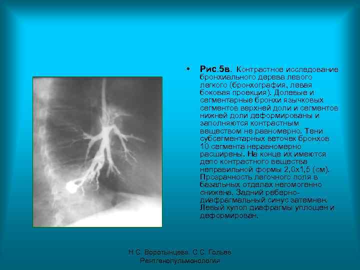  • Рис. 5 в. Контрастное исследование бронхиального дерева левого легкого (бронхография, левая боковая