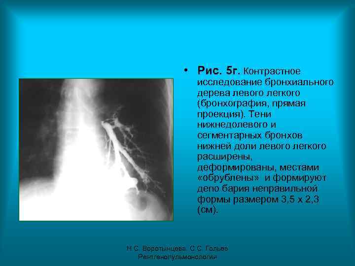  • Рис. 5 г. Контрастное исследование бронхиального дерева левого легкого (бронхография, прямая проекция).