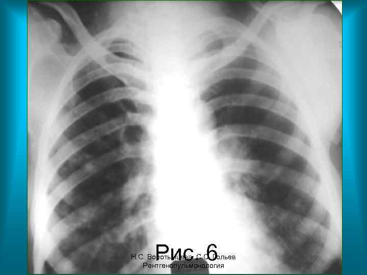 Рис. 6 Н. С. Воротынцева. С. С. Гольев Рентгенопульмонология 