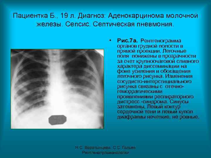 Пациентка Б. , 19 л. Диагноз: Аденокарцинома молочной железы. Сепсис. Септическая пневмония. • Рис.