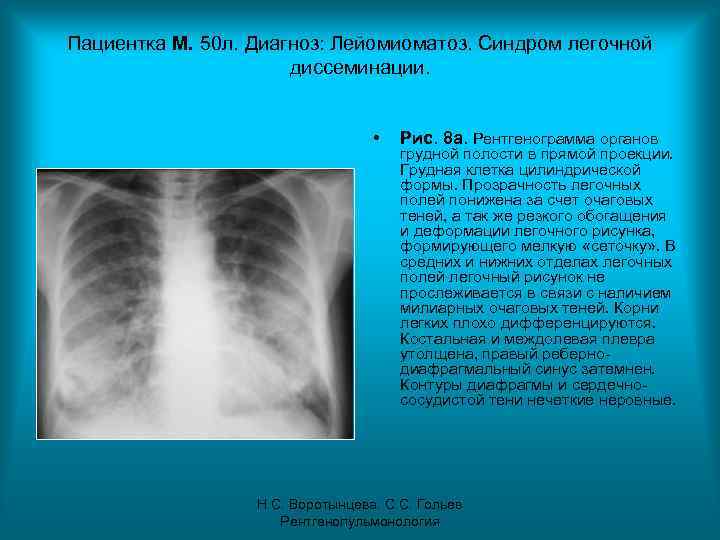 Пациентка М. 50 л. Диагноз: Лейомиоматоз. Синдром легочной диссеминации. • Рис. 8 а. Рентгенограмма