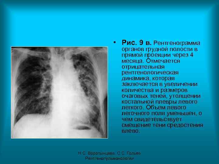  • Рис. 9 в. Рентгенограмма органов грудной полости в прямой проекции через 4