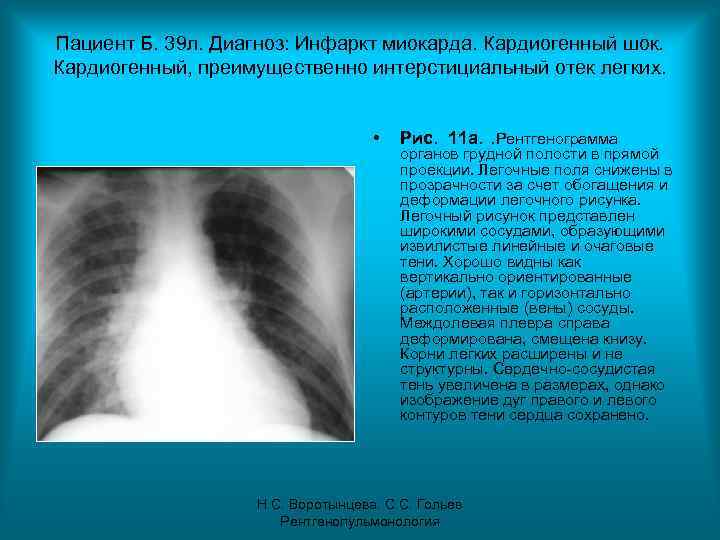Пациент Б. 39 л. Диагноз: Инфаркт миокарда. Кардиогенный шок. Кардиогенный, преимущественно интерстициальный отек легких.
