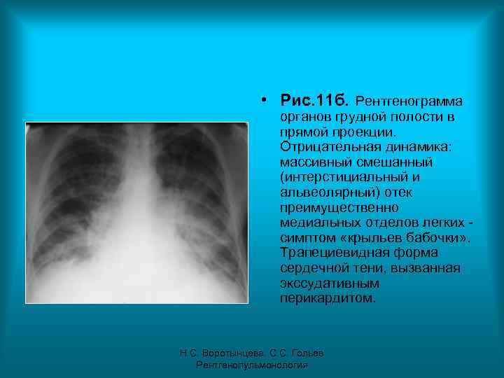  • Рис. 11 б. Рентгенограмма органов грудной полости в прямой проекции. Отрицательная динамика: