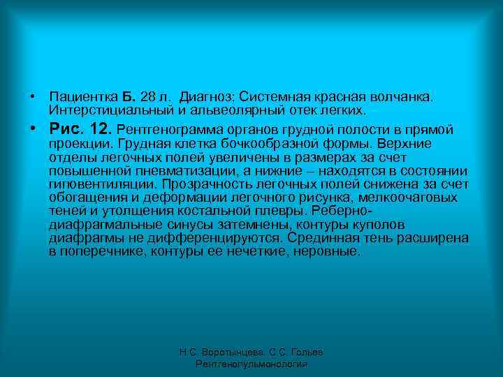 • Пациентка Б. 28 л. Диагноз: Системная красная волчанка. Интерстициальный и альвеолярный отек