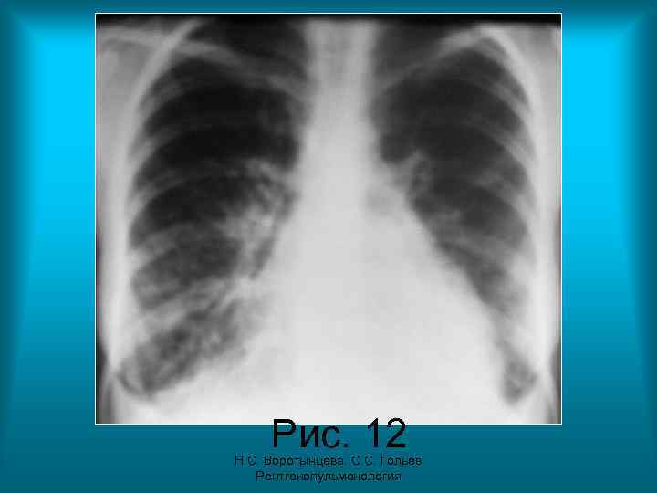 Рис. 12 Н. С. Воротынцева. С. С. Гольев Рентгенопульмонология 