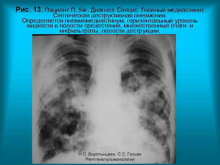 Рис. 13. Пациент П. 54 г. Диагноз: Сепсис. Гнойный медиастинит. Септическая деструктивная пневмония. Определяется