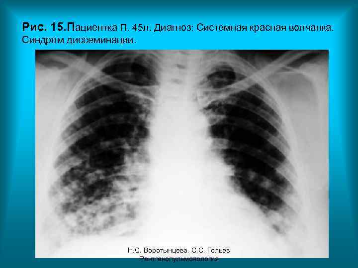 Рис. 15. Пациентка П. 45 л. Диагноз: Системная красная волчанка. Синдром диссеминации. Н. С.