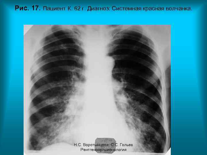 Рис. 17. Пациент К. 62 г. Диагноз: Системная красная волчанка. Н. С. Воротынцева. С.