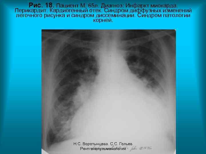 Рис. 18. Пациент М. 65 л. Диагноз: Инфаркт миокарда. Перикардит. Кардиогенный отек. Синдром диффузных