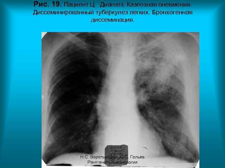 Рис. 19. Пациент Ц. Диагноз: Казеозная пневмония. Диссеминированный туберкулез легких. Бронхогенная диссеминация. Н. С.