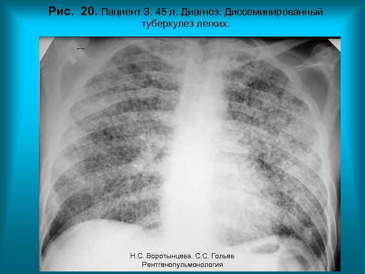 Рис. 20. Пациент З. 45 л. Диагноз: Диссеминированный туберкулез легких. Н. С. Воротынцева. С.