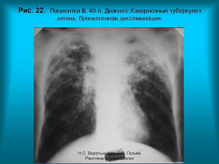 Рис. 22. Пациентка В. 40 л. Диагноз: Кавернозный туберкулез легких, бронхогенная диссеминация. Н. С.