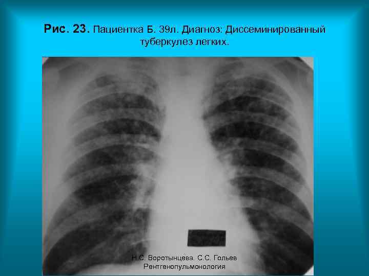 Рис. 23. Пациентка Б. 39 л. Диагноз: Диссеминированный туберкулез легких. Н. С. Воротынцева. С.