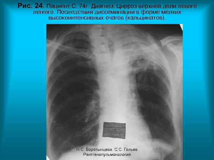 Рис. 24. Пациент С. 74 г. Диагноз: Цирроз верхней доли левого легкого. Последствия диссеминации