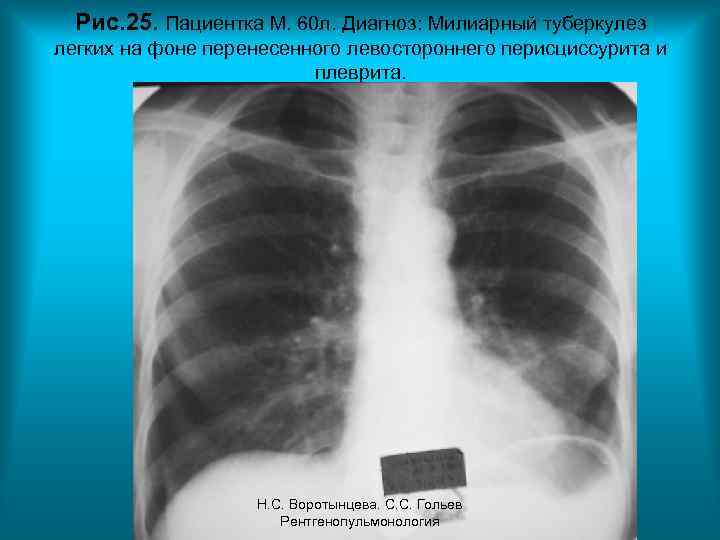 Рис. 25. Пациентка М. 60 л. Диагноз: Милиарный туберкулез легких на фоне перенесенного левостороннего