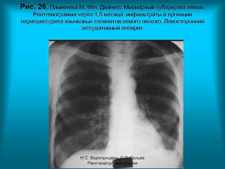 Рис. 26. Пациентка М. 60 л. Диагноз: Милиарный туберкулез легких. Рентгенограмма через 1, 5