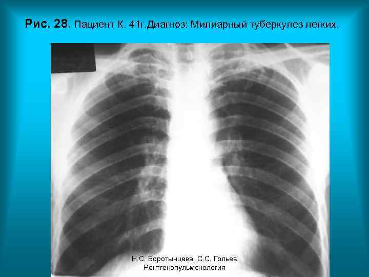 Рис. 28. Пациент К. 41 г. Диагноз: Милиарный туберкулез легких. Н. С. Воротынцева. С.