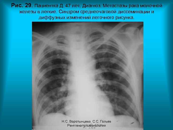 Рис. 29. Пациентка Д. 47 лет. Диагноз: Метастазы рака молочной железы в легкие. Синдром