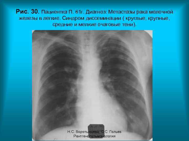Рис. 30. Пациентка П. 61 г. Диагноз: Метастазы рака молочной железы в легкие. Синдром