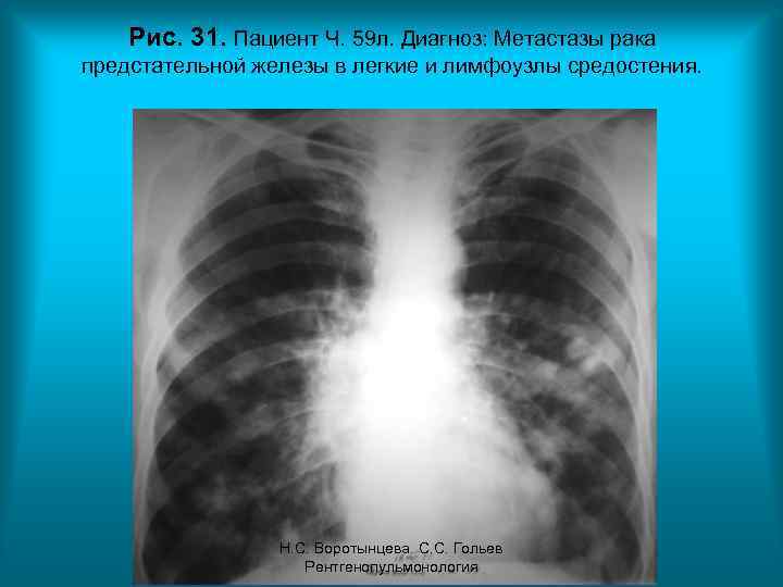 Рис. 31. Пациент Ч. 59 л. Диагноз: Метастазы рака предстательной железы в легкие и