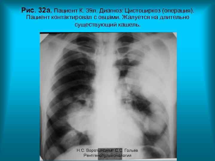 Рис. 32 а. Пациент К. 39 л. Диагноз: Цистоциркоз (операция). Пациент контактировал с овцами.