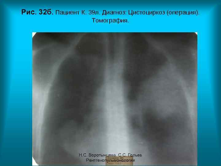 Рис. 32 б. Пациент К. 39 л. Диагноз: Цистоциркоз (операция). Томография. Н. С. Воротынцева.