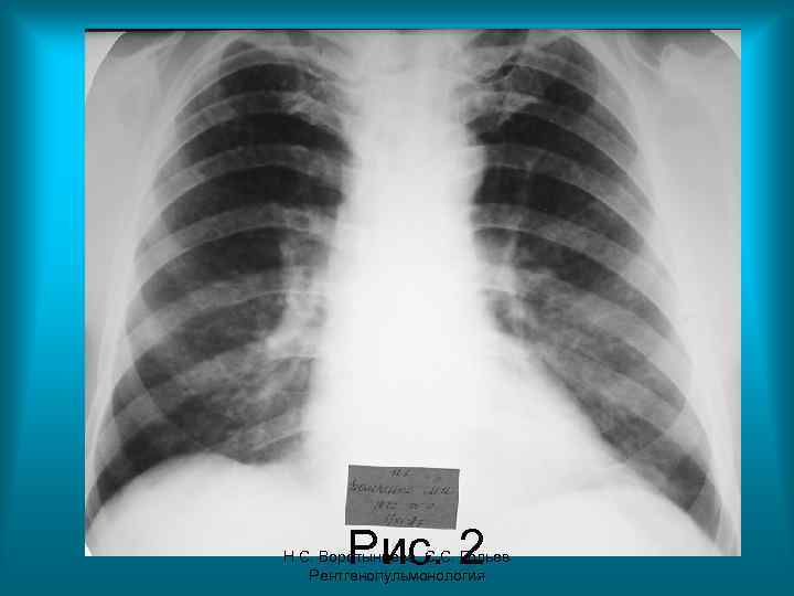Рис. 2 Н. С. Воротынцева. С. С. Гольев Рентгенопульмонология 