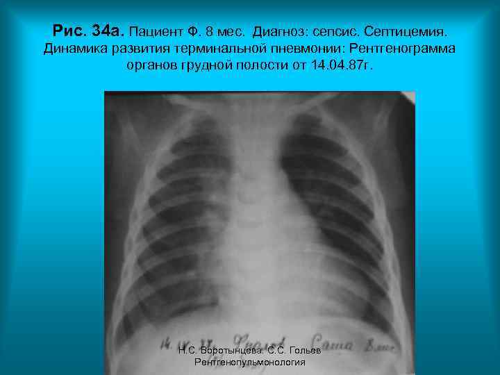 Рис. 34 а. Пациент Ф. 8 мес. Диагноз: сепсис. Септицемия. Динамика развития терминальной пневмонии: