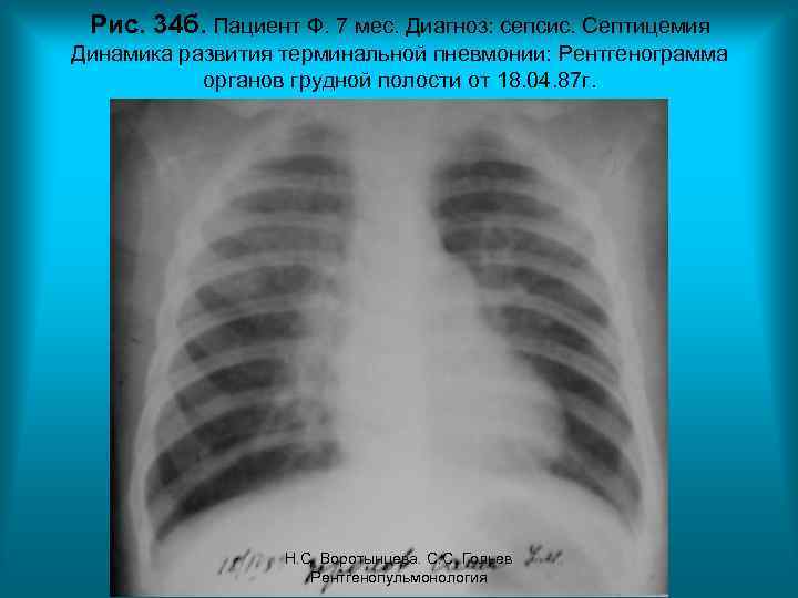 Рис. 34 б. Пациент Ф. 7 мес. Диагноз: сепсис. Септицемия Динамика развития терминальной пневмонии: