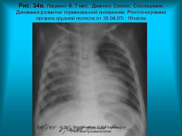 Рис. 34 в. Пациент Ф. 7 мес. Диагноз: Сепсис. Септицемия. Динамика развития терминальной пневмонии: