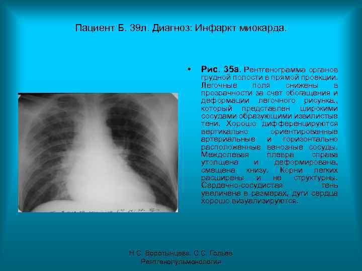 Пациент Б. 39 л. Диагноз: Инфаркт миокарда. • Рис. 35 а. Рентгенограмма органов грудной
