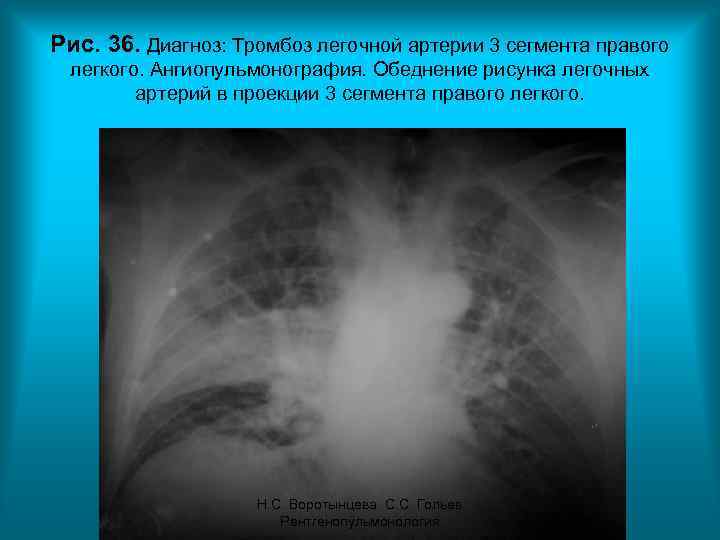Рис. 36. Диагноз: Тромбоз легочной артерии 3 сегмента правого легкого. Ангиопульмонография. Обеднение рисунка легочных
