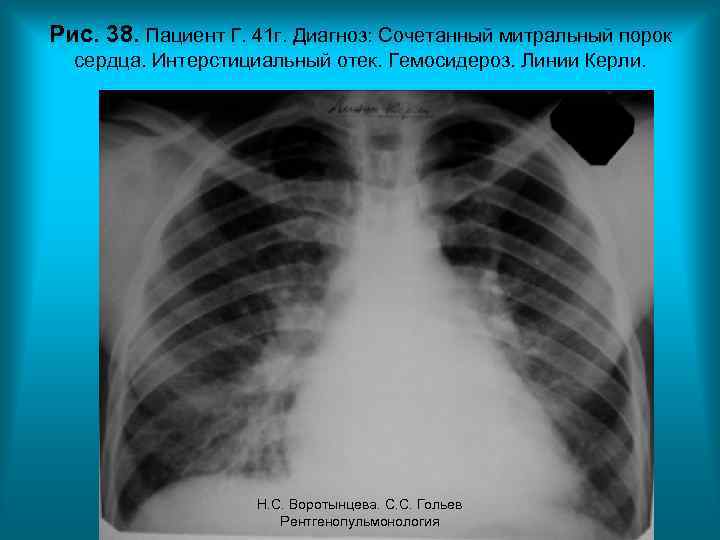Рис. 38. Пациент Г. 41 г. Диагноз: Сочетанный митральный порок сердца. Интерстициальный отек. Гемосидероз.