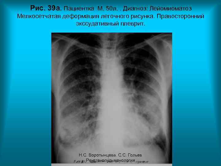 Рис. 39 а. Пациентка М. 50 л. . Диагноз: Лейомиоматоз Мелкосетчатая деформация легочного рисунка.