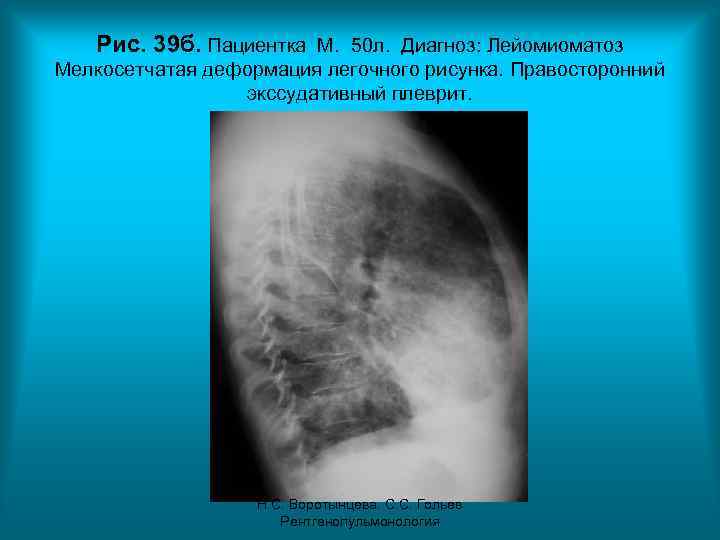 Рис. 39 б. Пациентка М. 50 л. Диагноз: Лейомиоматоз Мелкосетчатая деформация легочного рисунка. Правосторонний