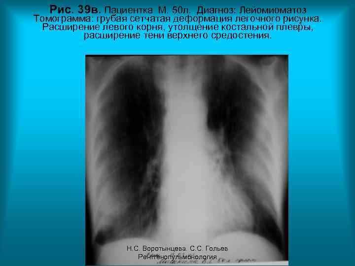 Рис. 39 в. Пациентка М. 50 л. Диагноз: Лейомиоматоз Томограмма: грубая сетчатая деформация легочного