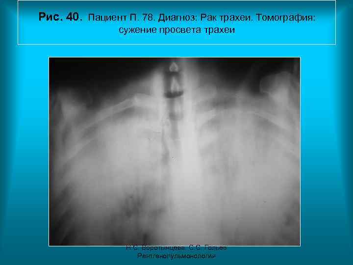 Рис. 40. Пациент П. 78. Диагноз: Рак трахеи. Томография: сужение просвета трахеи Н. С.