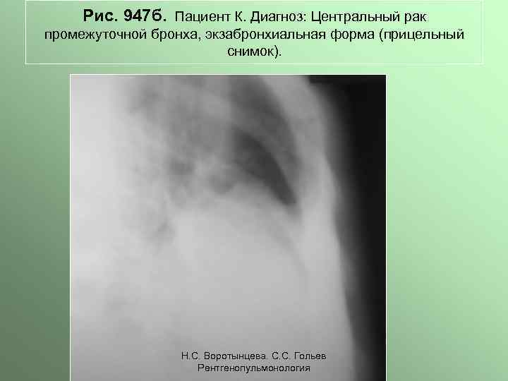 Рис. 947 б. Пациент К. Диагноз: Центральный рак промежуточной бронха, экзабронхиальная форма (прицельный снимок).