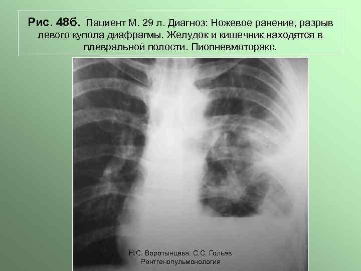 Рис. 48 б. Пациент М. 29 л. Диагноз: Ножевое ранение, разрыв левого купола диафрагмы.