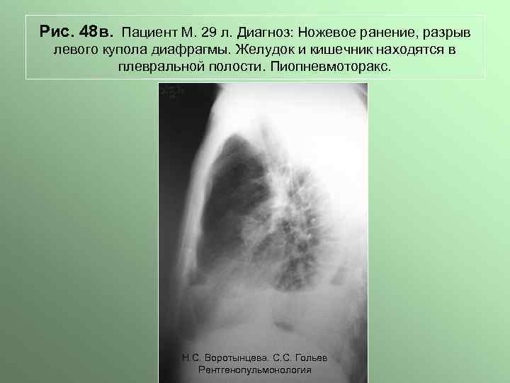 Рис. 48 в. Пациент М. 29 л. Диагноз: Ножевое ранение, разрыв левого купола диафрагмы.